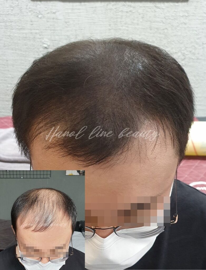 풍무동두피문신