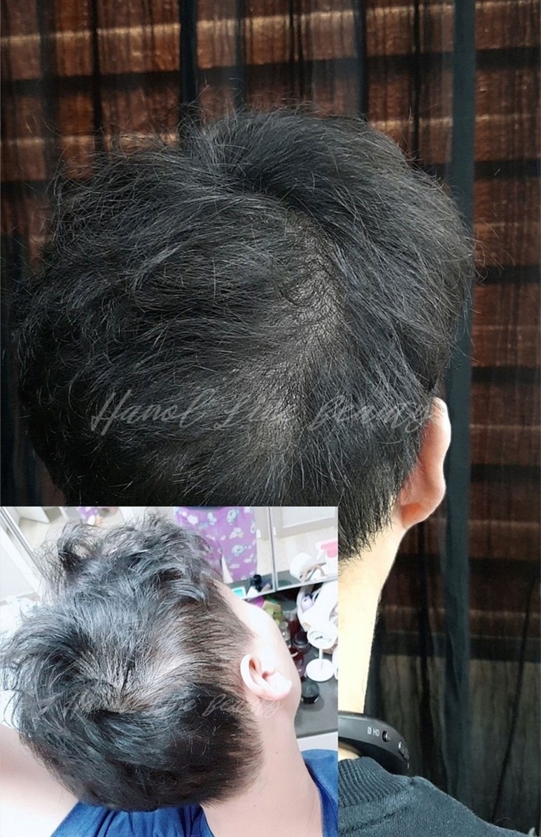 파주smp두피문신