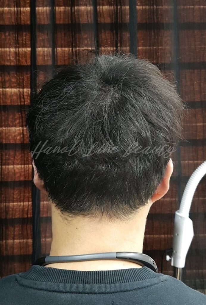 두피문신잘하는곳