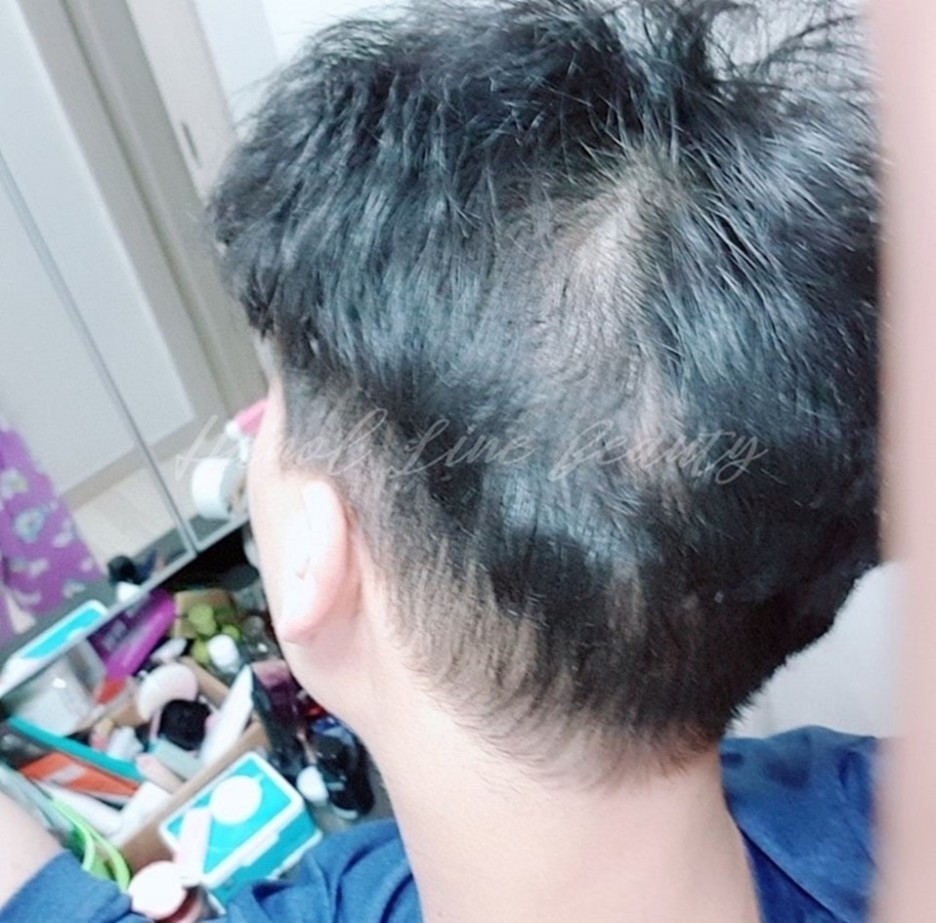 김포smp두피문신