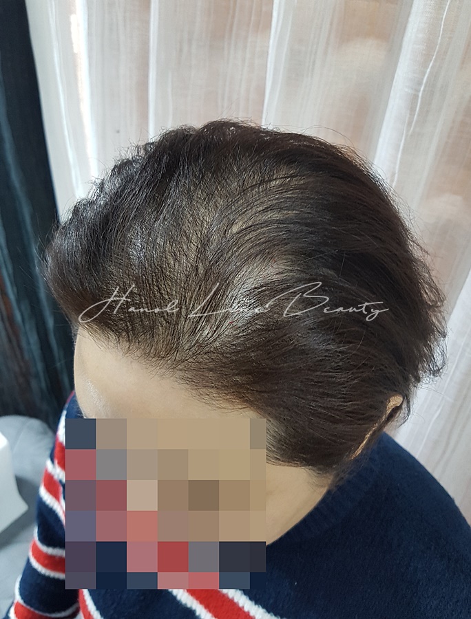 일산smp두피문신