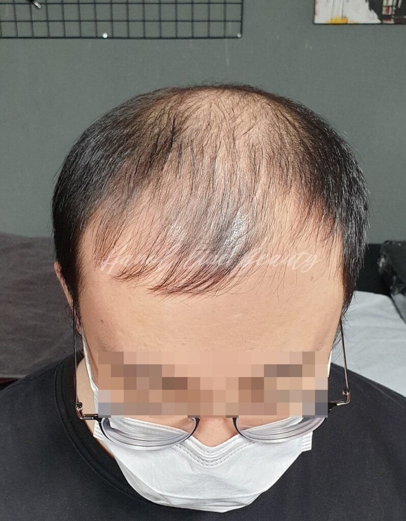 김포탈모커버