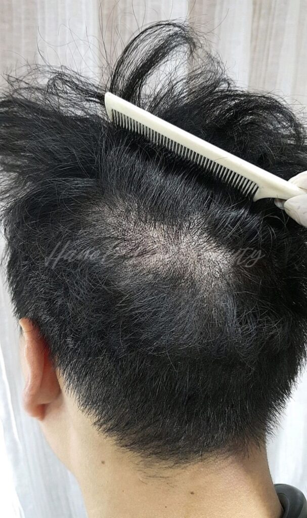 김포두피문신하는곳