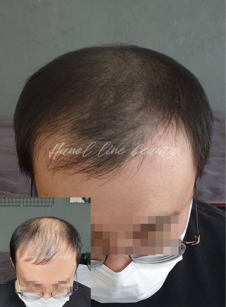 김포두피문신하는곳