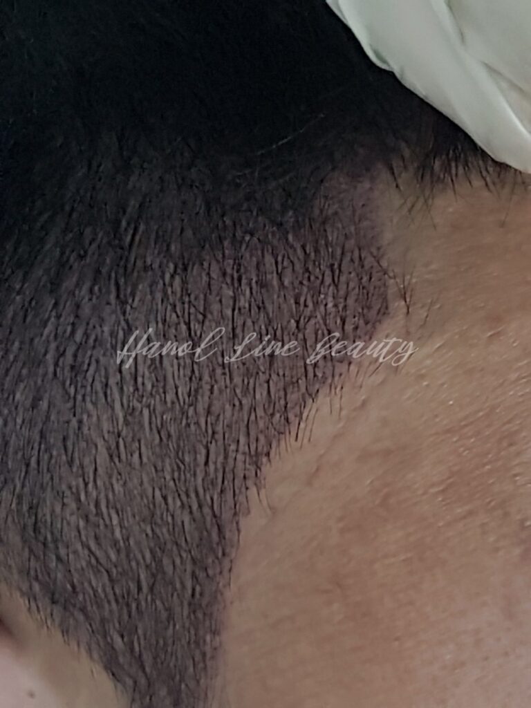 부천smp두피문신