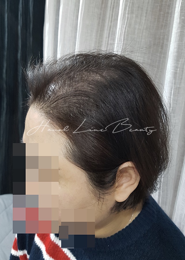 헤어라인