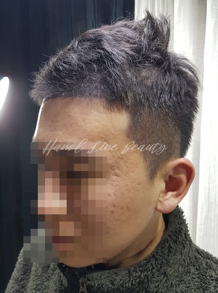 부천두피문신하는곳