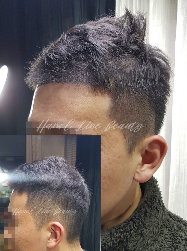 부천두피타투