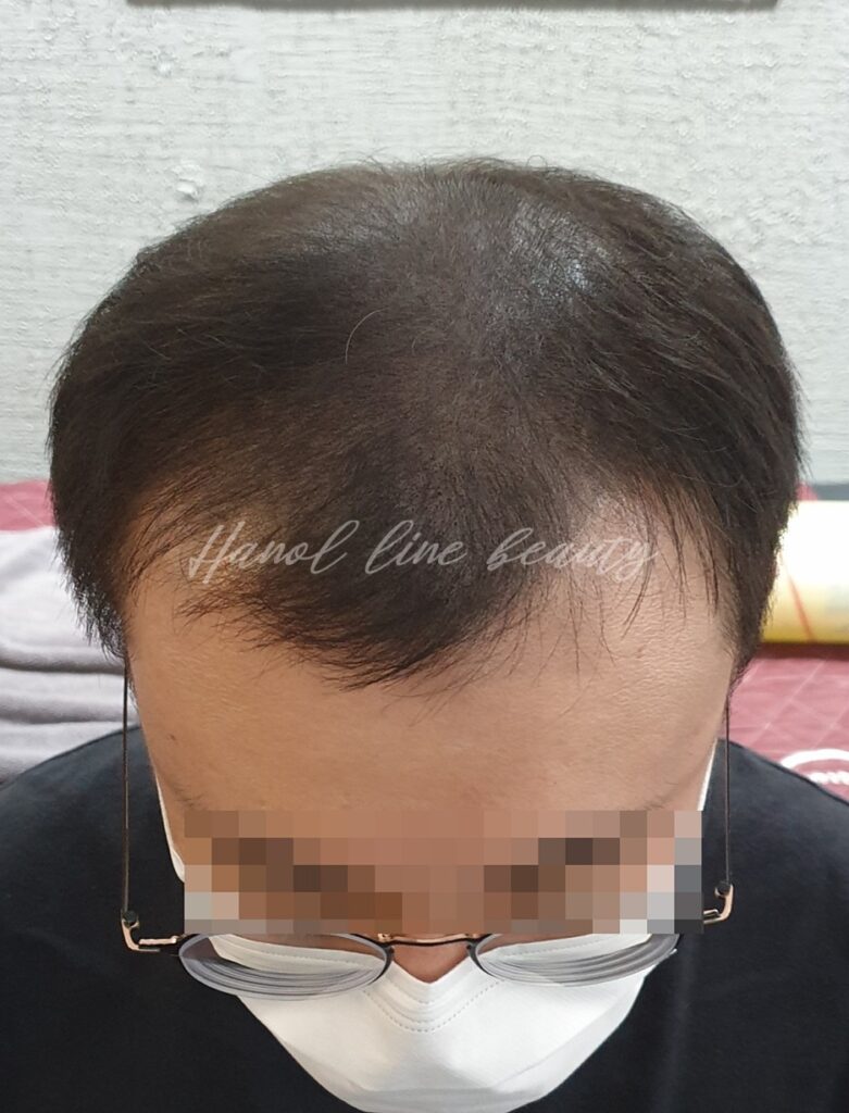 고촌두피문신