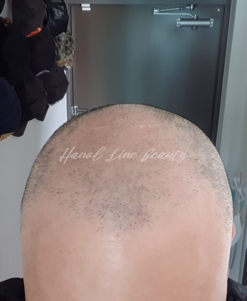 의정부두피문신