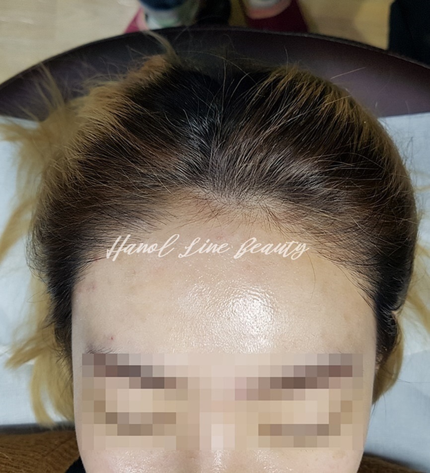 일산두피문신