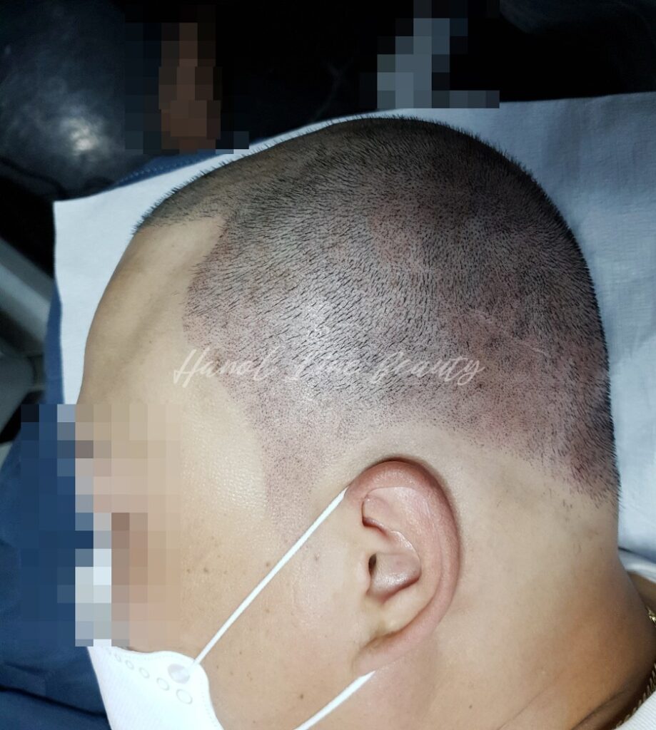 머리흉터커버