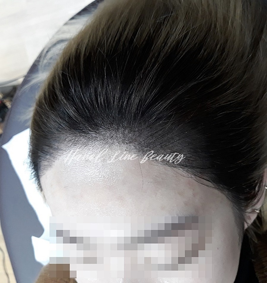 여성두피문신