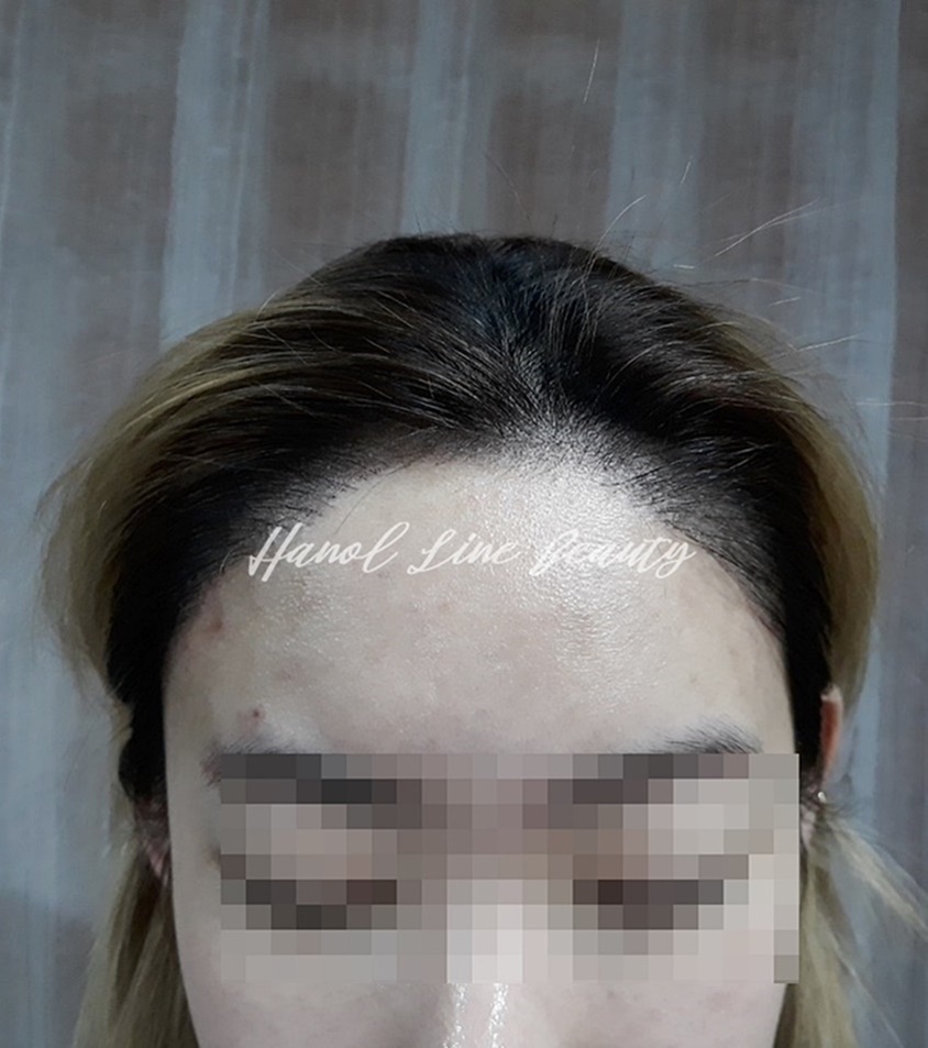 구래동두피문신