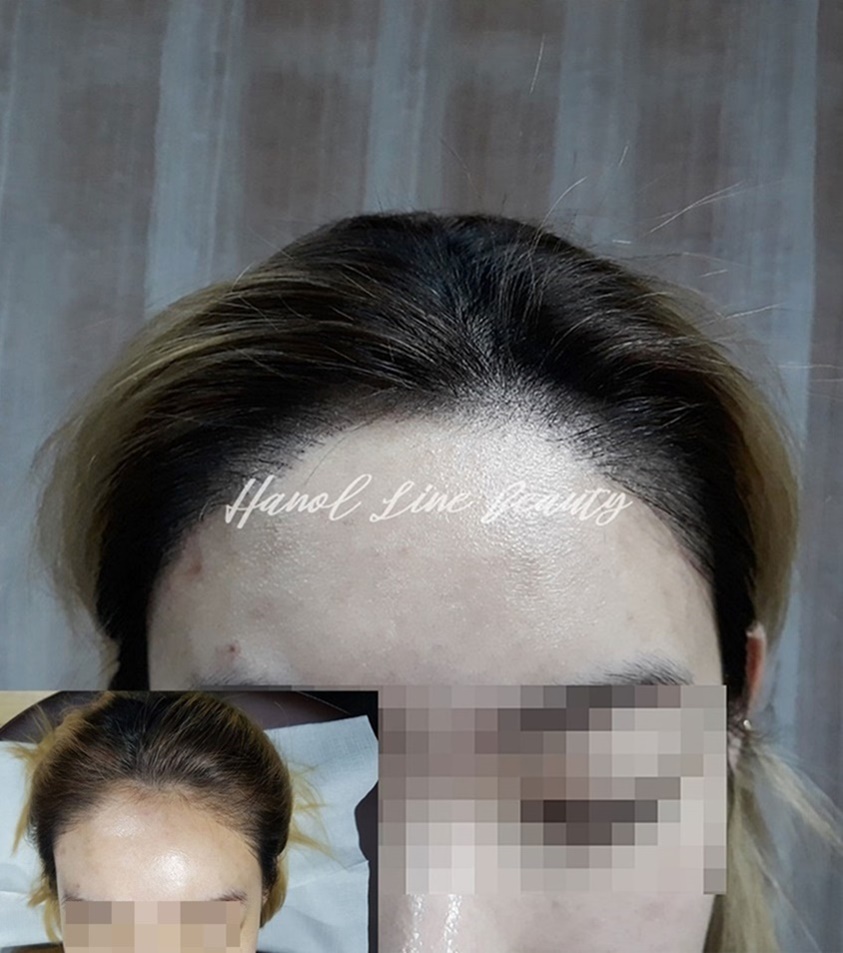 장기동두피문신