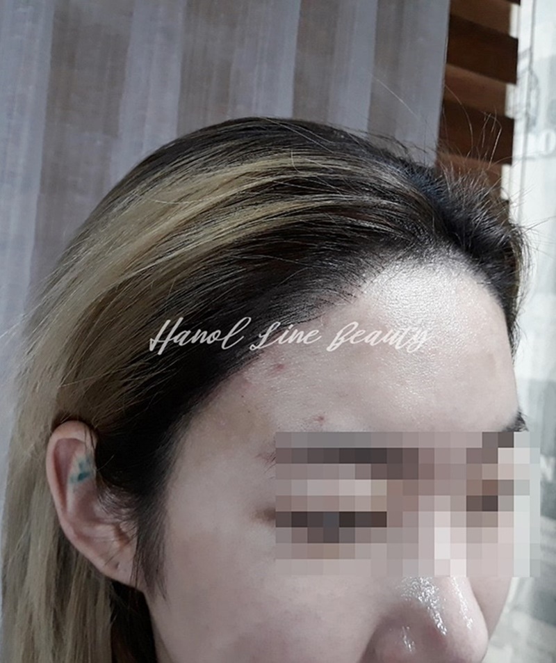 인천두피문신