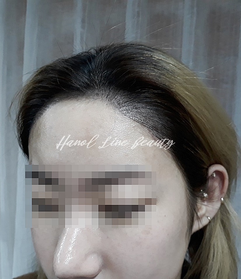 풍무동두피문신