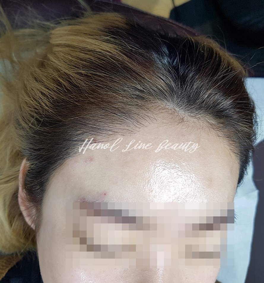 여성정수리두피문신