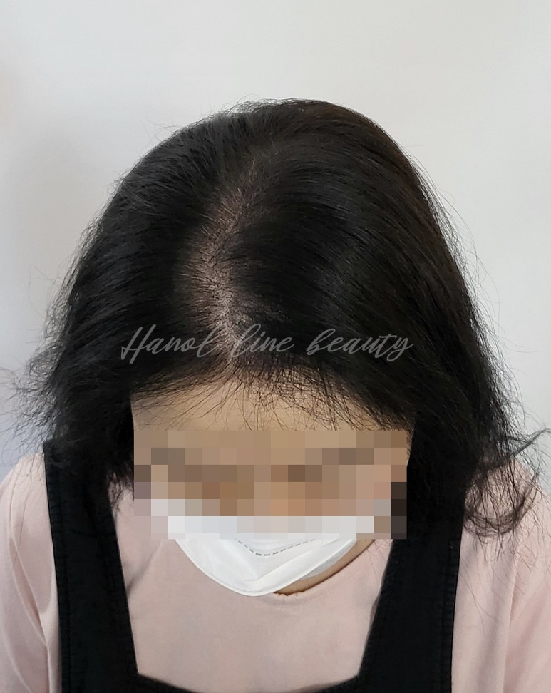 인천smp두피문신