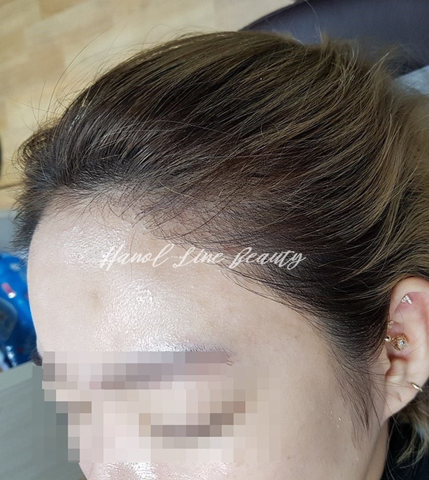 여성탈모커버
