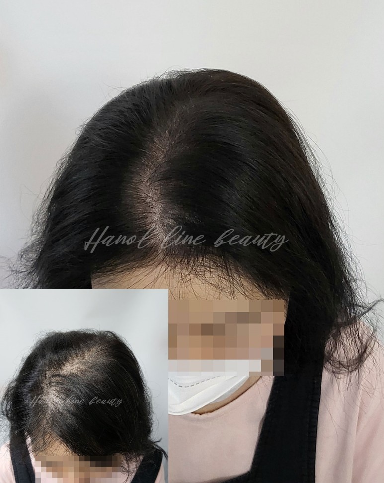인천정수리두피문신