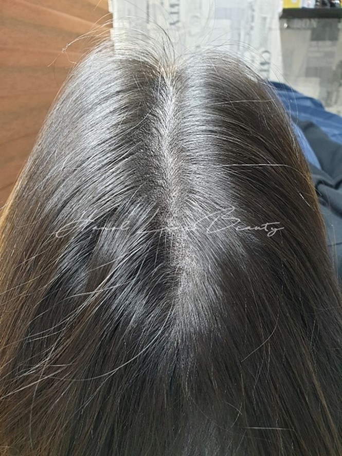 여성탈모커버