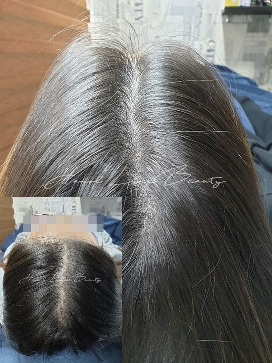 인천두피문신