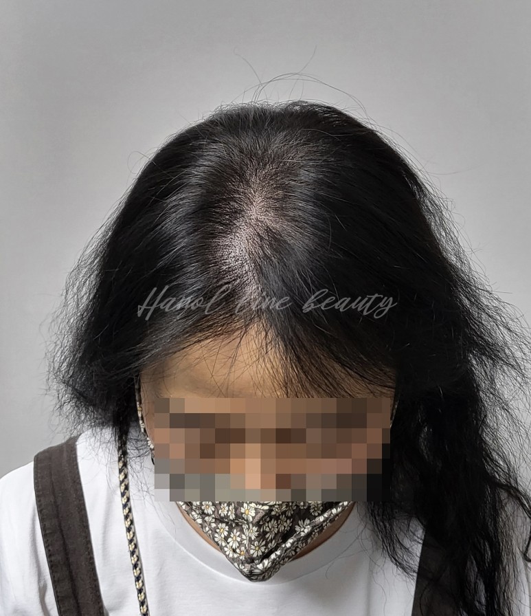 여성두피탈모