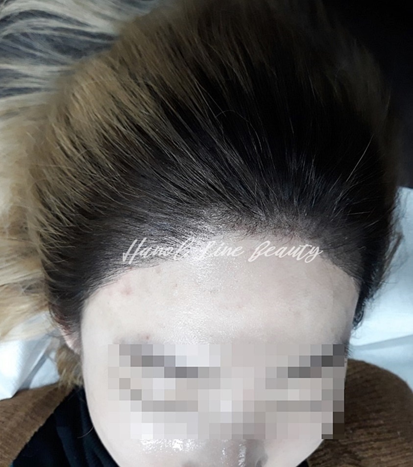 헤어라인