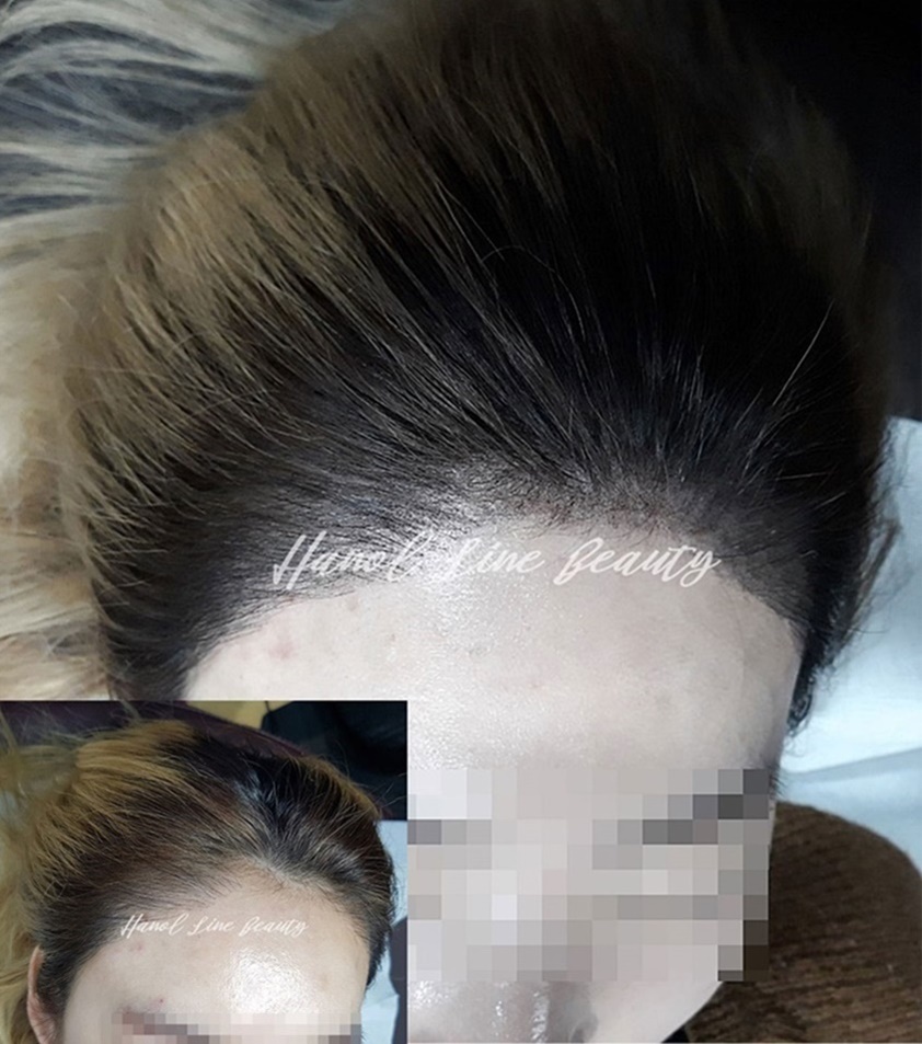 탈모커버
