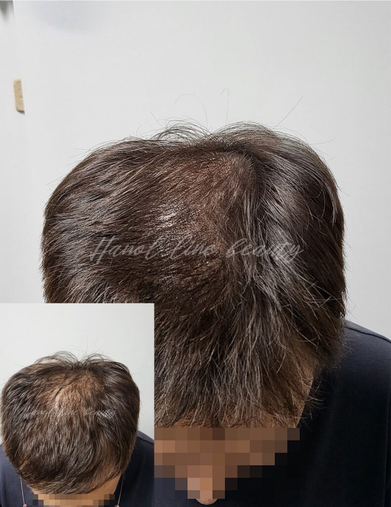 운양동두피문신