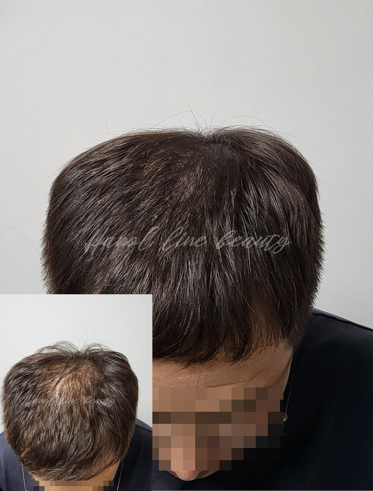 검단두피문신