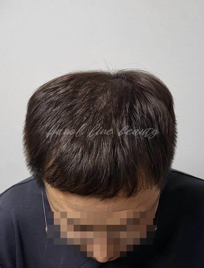 smp두피문신