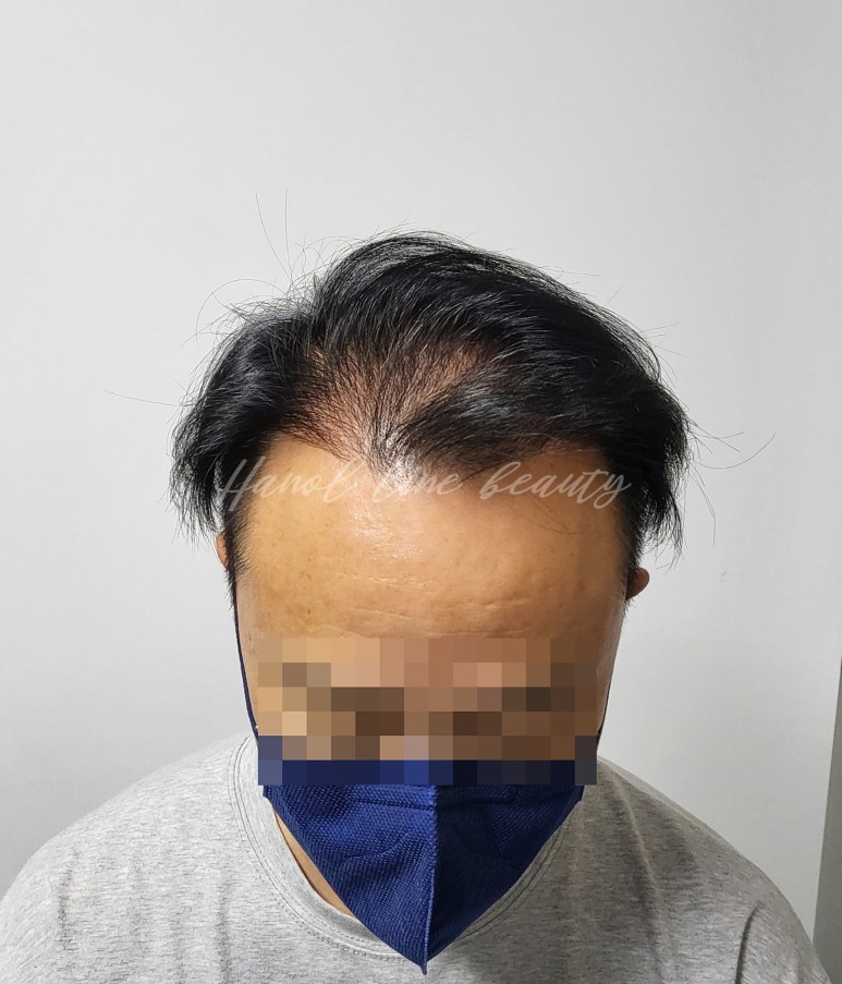 일산두피문신