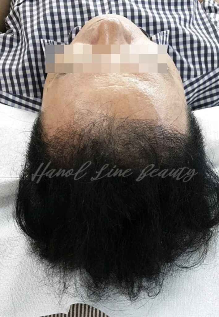 파주두피문신