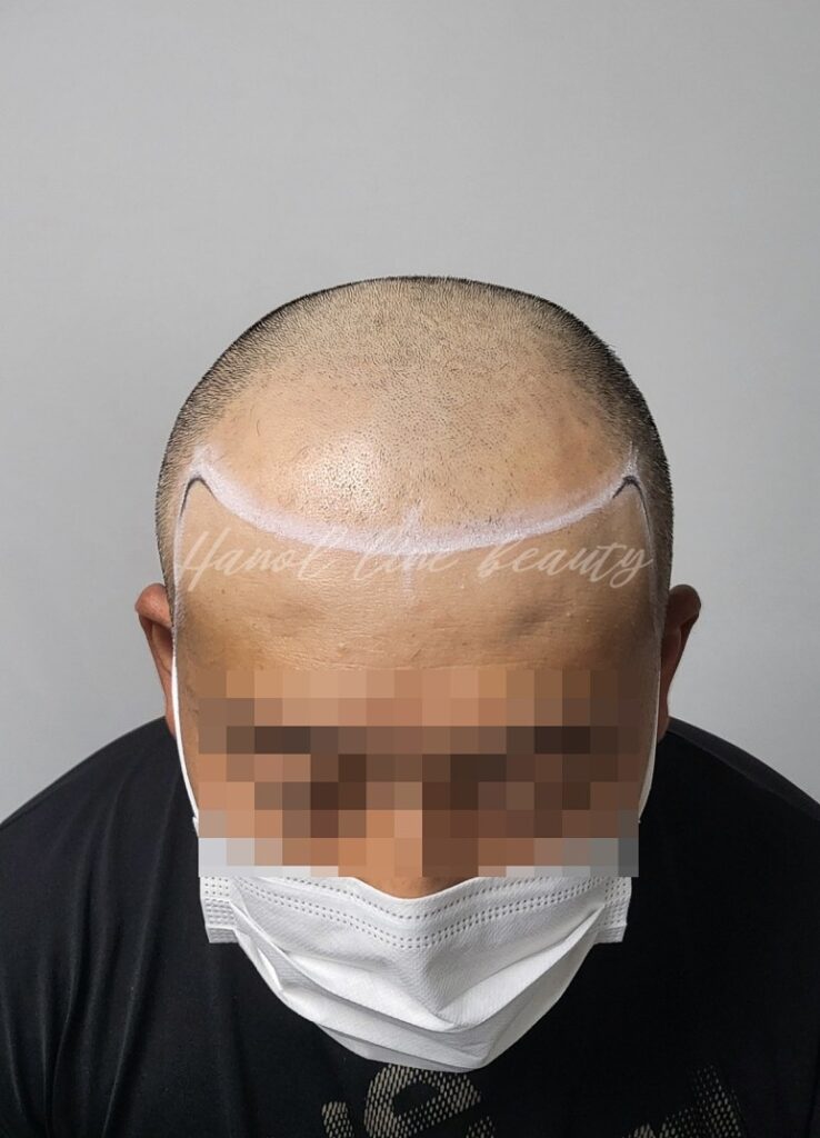 김포두피문신