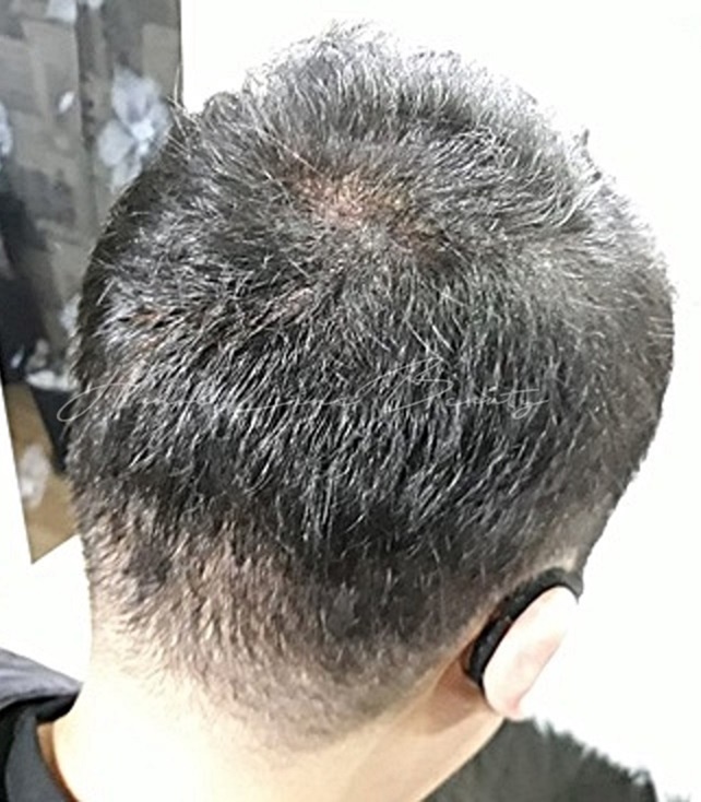일산두피문신