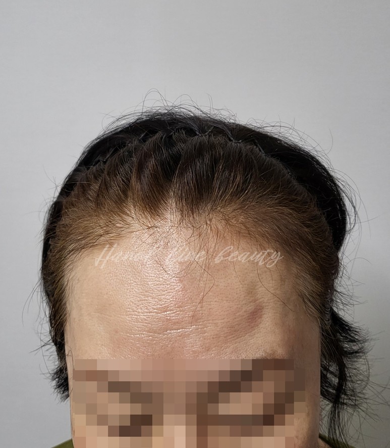 일산두피문신