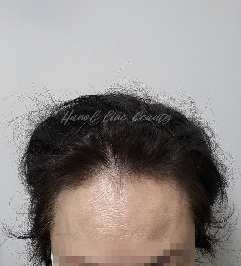 일산smp두피문신
