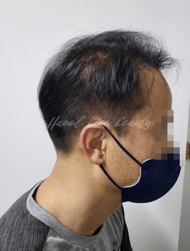 여성두피문신