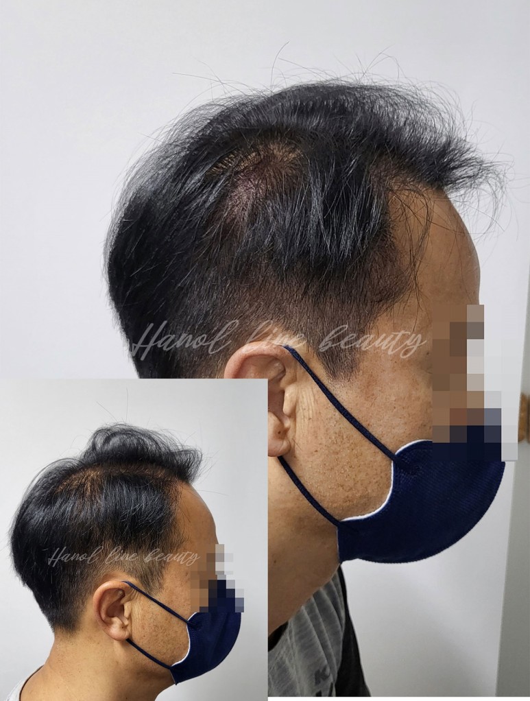 가르마문신