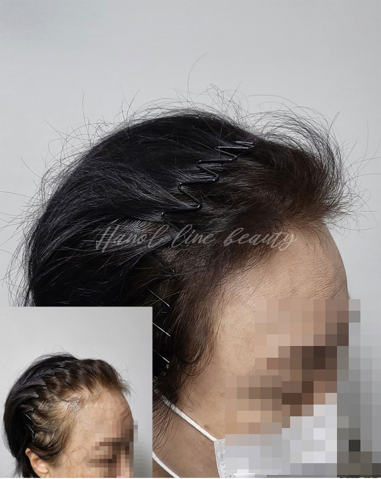안면거상후
