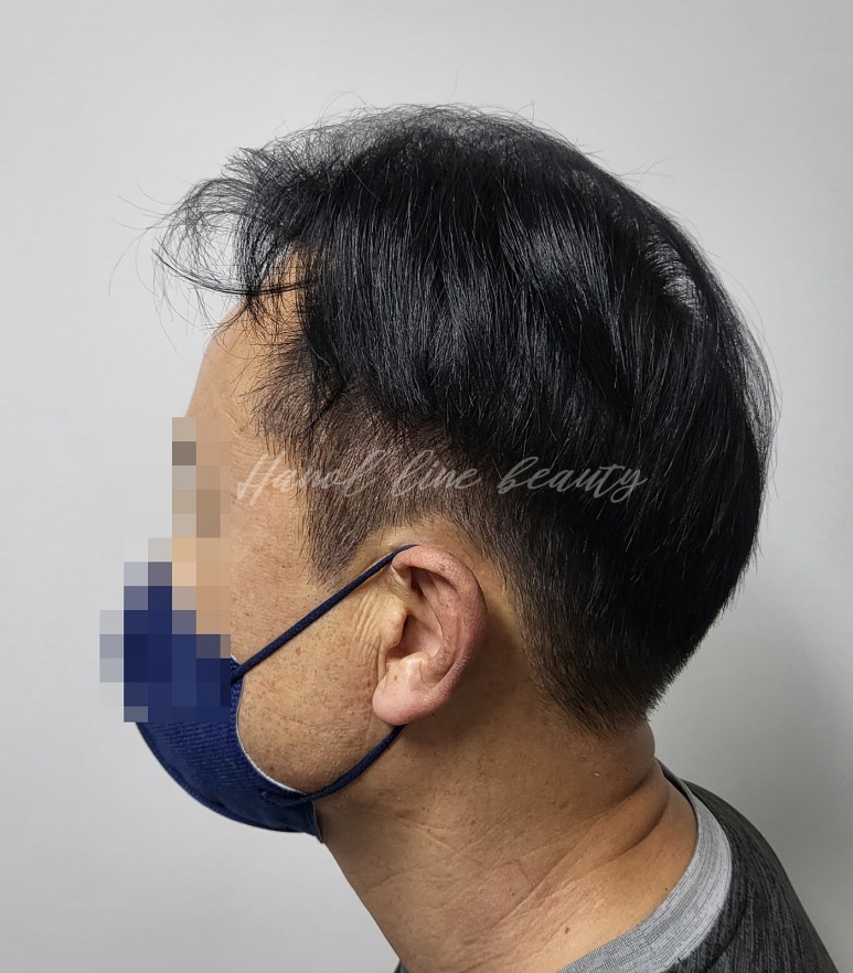 헤어라인