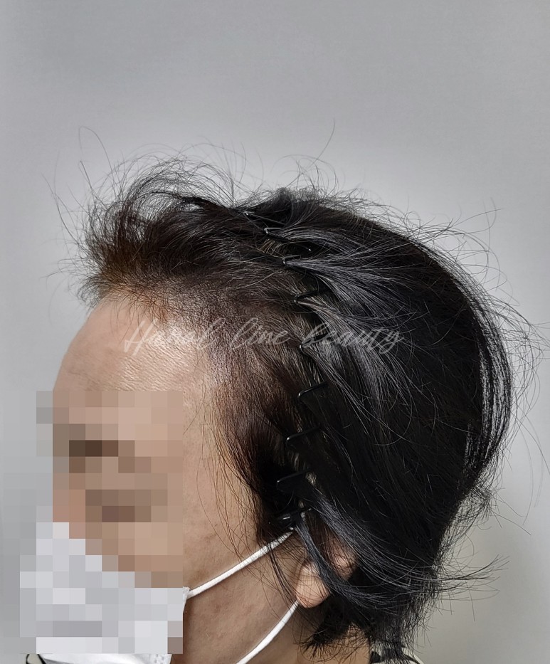 머리흉터커버