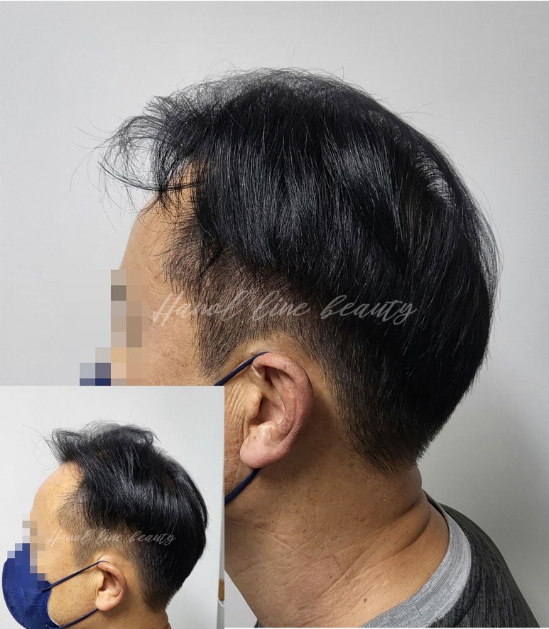 SMP두피문신