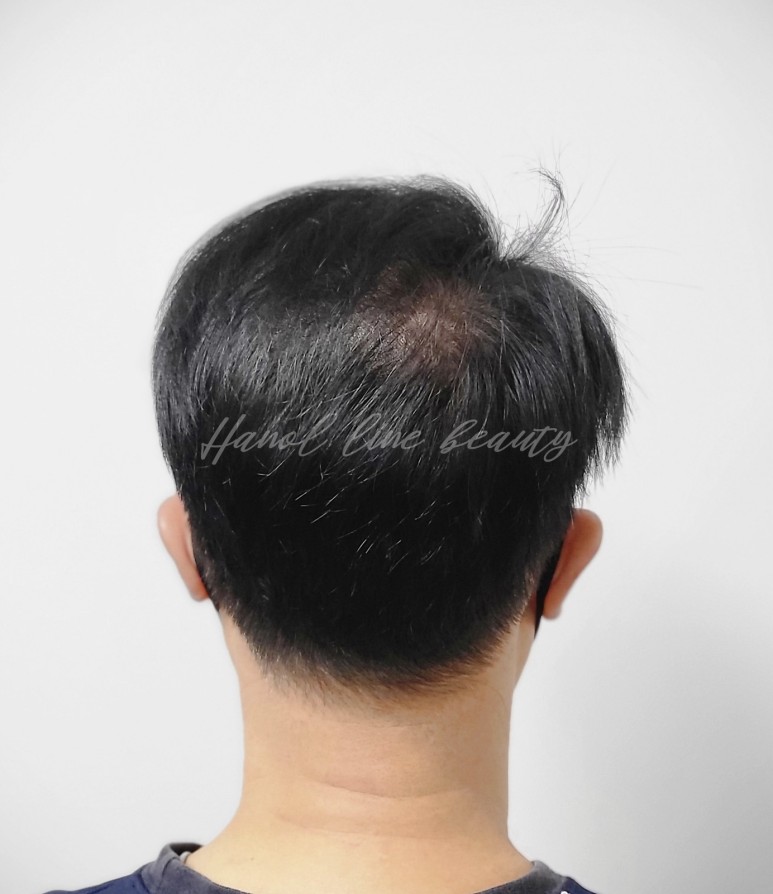 일산두피문신잘하는곳
