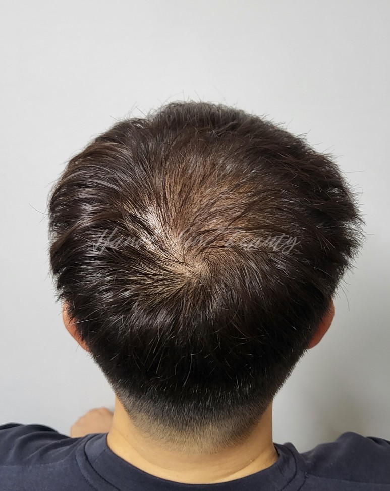 일산smp두피문신