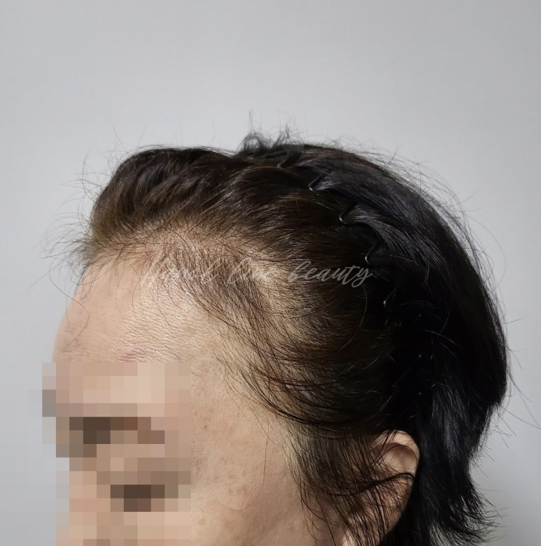 일산smp두피문신