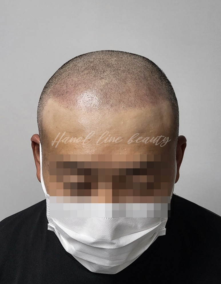 구래동두피문신