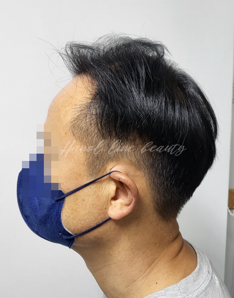 두피문신으로